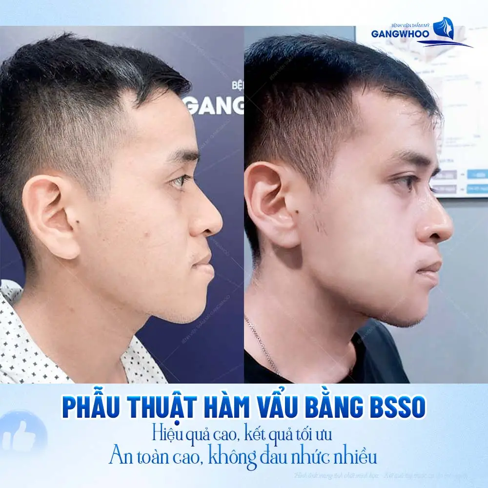 Phẫu thuật hàm vẩu bằng BSSO hiệu quả cao, kết quả thẩm mỹ tối ưu, an toàn và không đau nhức nhiều 