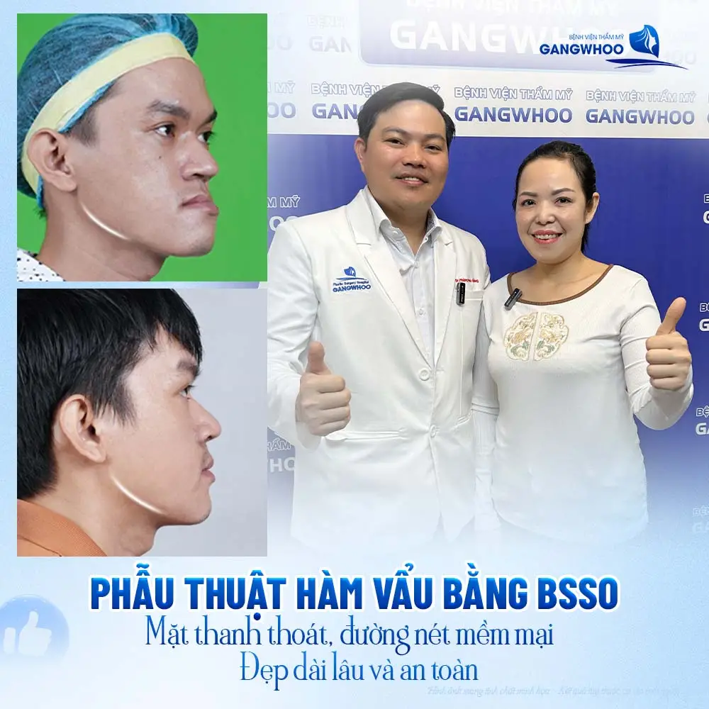 Phẫu thuật hàm vẩu bằng BSSO mặt thanh thoát, đường nét mềm mại đẹp dài lâu và an toàn hơn