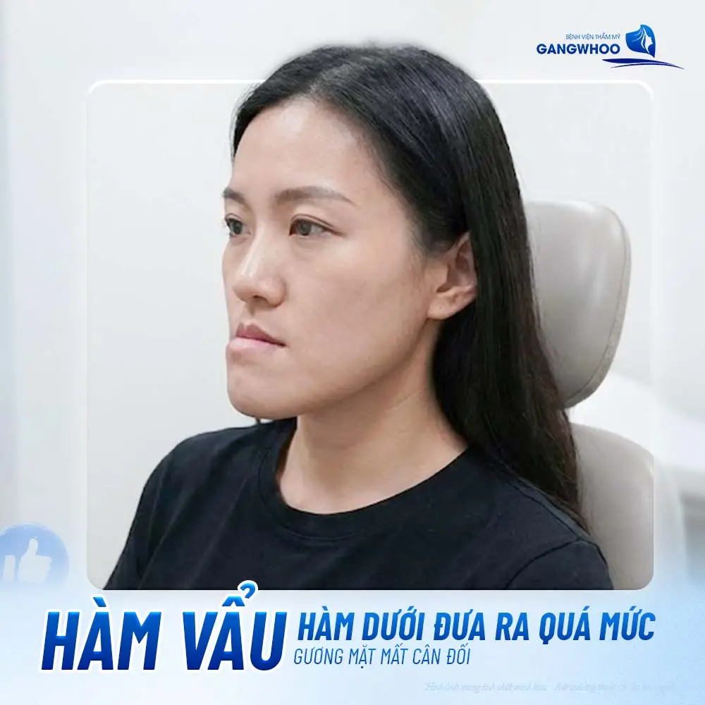Hàm vẩu hàm dưới đưa ra quá mức gương mặt mất cân đối