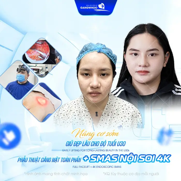 Căng Da Mặt Nội Soi Ở Đâu? 7 Địa Chỉ Uy Tín Tại TPHCM 17 Phẫu thuật căng da mặt toàn phần nâng cơ sớm giữ trọn vẻ đẹp dài lâu cho mọi độ tuổi