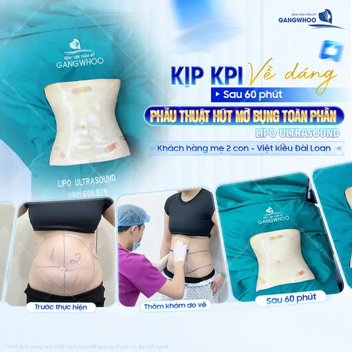 Phẫu thuật hút mỡ bụng toàn phần về dáng nuột tự tin khoe eo thon khi vừa thực hiện xong 