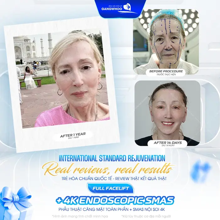 Căng Da Mặt Nội Soi Ở Đâu? 7 Địa Chỉ Uy Tín Tại TPHCM 12 Phẫu thuật căng da mặt toàn phần trẻ hóa chuẩn đẹp với kết quả thay đổi rõ rệt