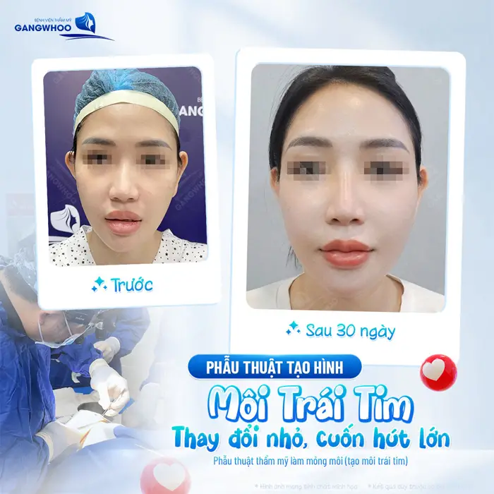 Tạo Hình Môi Trái Tim Cho Đôi Môi Quyến Rũ Mọi Chàng Trai 5 Phẫu thuật tạo hình môi trái tim thay đổi nhỏ, cuốn hút lỡn sau 30 ngày đã hoàn toàn khác biệt