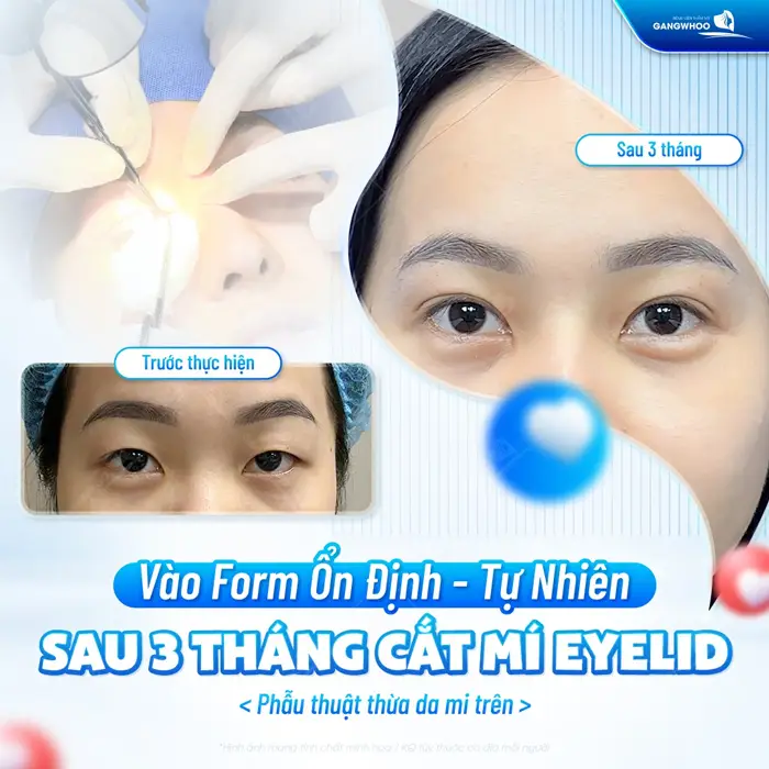 Phẫu thuật thừa da mi trên vào form ổn định tự nhiên sau 3 tháng thực hiện 