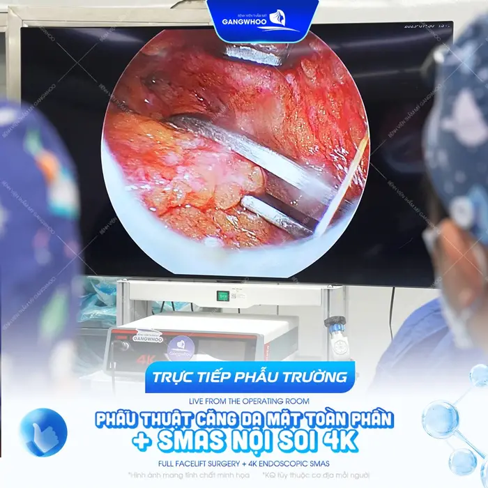 phau truong cang da mat smas 1