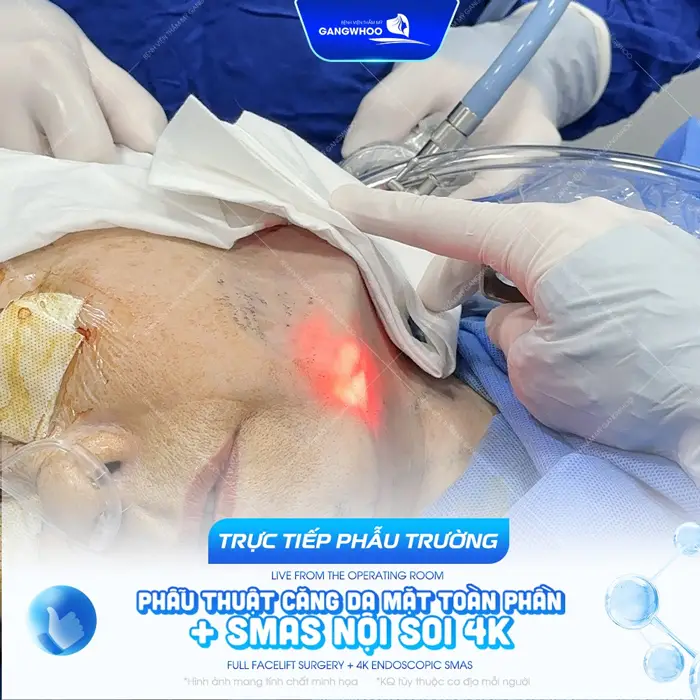 phau truong cang da mat smas 2