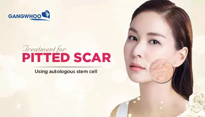 pitted scar treatment 1