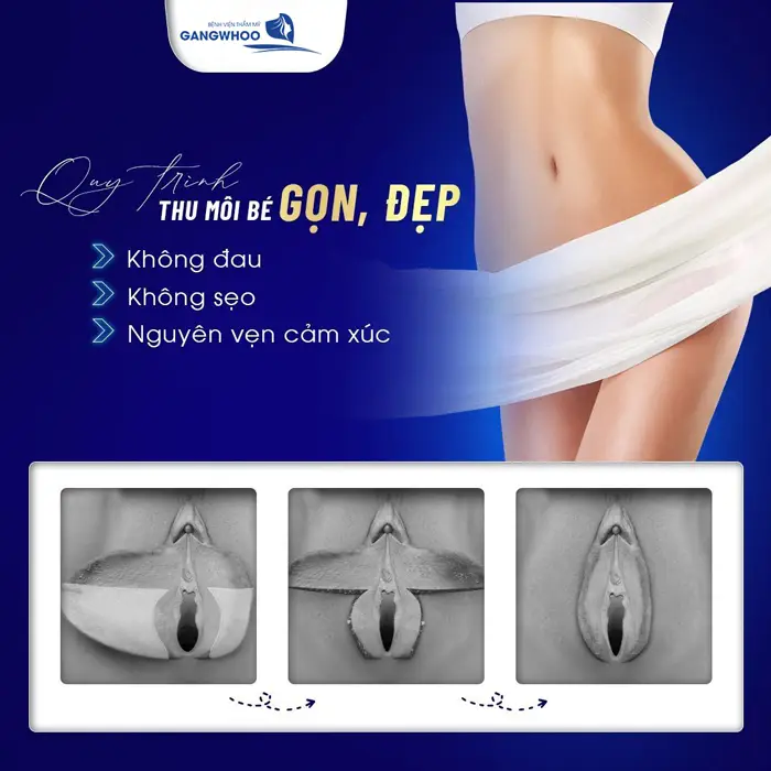 Quy trình các bước thu gọn môi bé đẹp chuẩn an toàn, không đau, không sẹo tại Gangwhoo