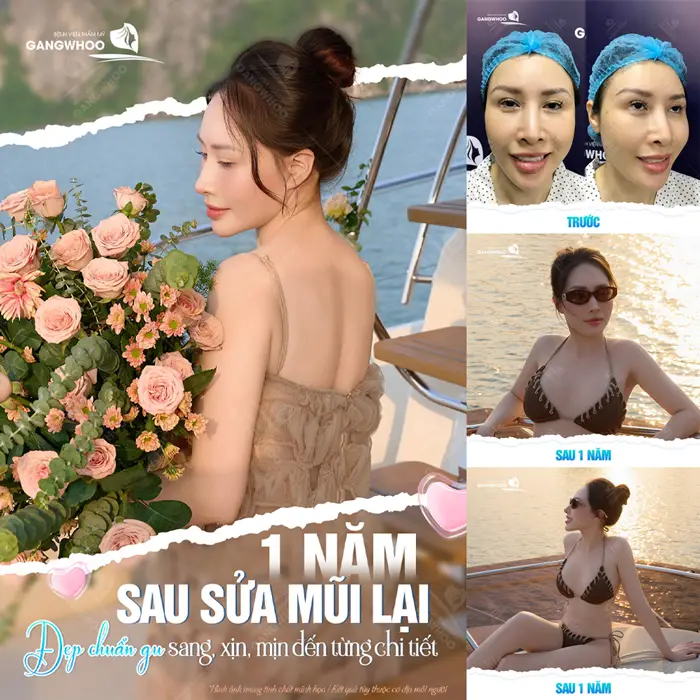 Sau 1 năm sửa mũi lại đẹp chuẩn gu sang, xịn, mịn đến từng chi tiết