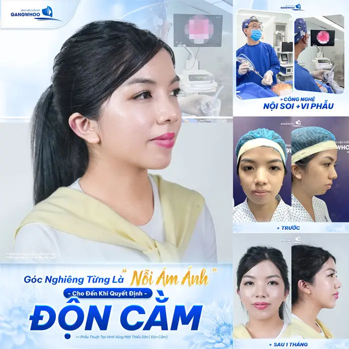 Độn Cằm Korea Implant Sở Hữu Gương Mặt V-Line Nhanh Chóng 2 Độn cằm cải thiện góc nghiêng thăng hạng diện mạo cho đường nét gương mặt thêm cuốn hút và rạng rỡ