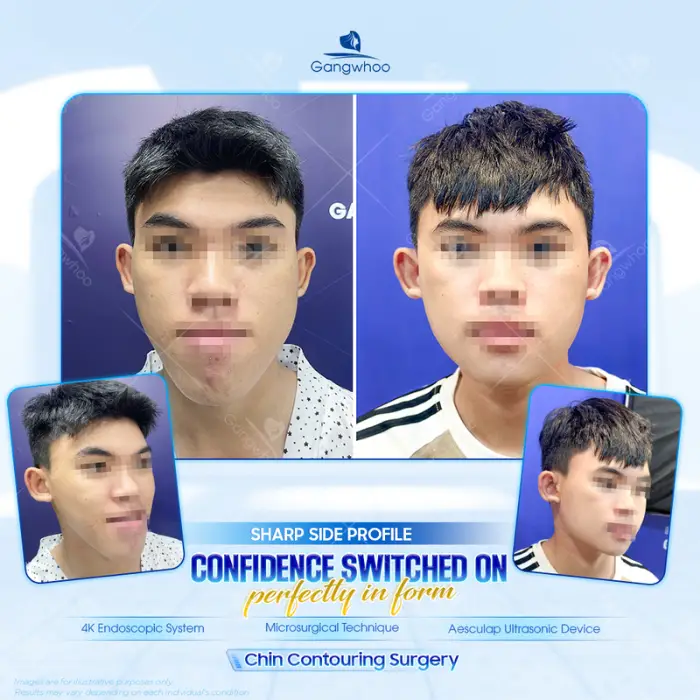 sliding genioplasty