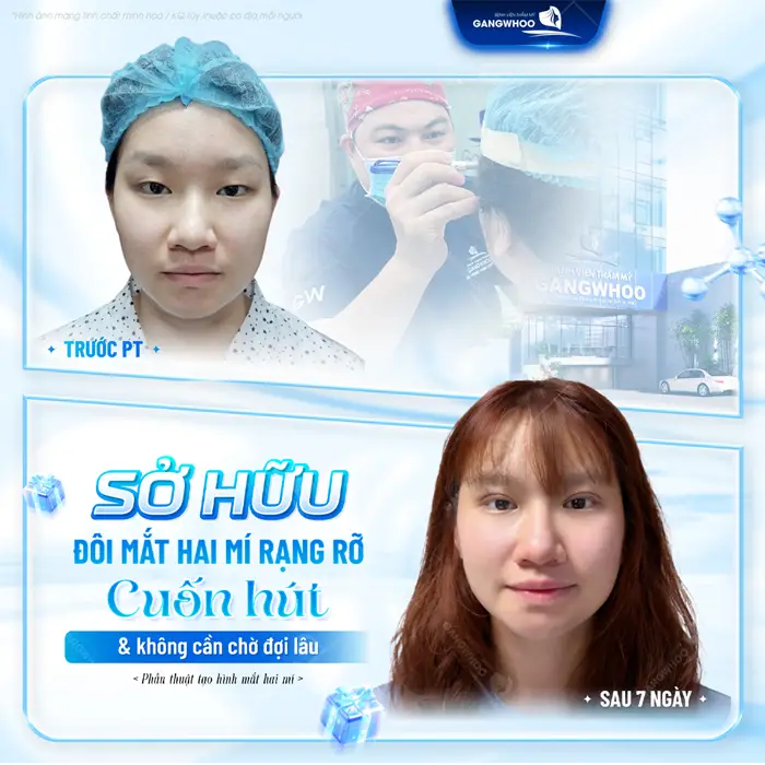 Top 7 Bệnh Viện Cắt Mí Đẹp Tại TPHCM Được Nhiều Người Lựa Chọn 1 Sở hữu đôi mắt 2 mí đẹp cuốn hút an toàn, hiệu quả và do chính bác sĩ chuyên môn thực hiện tại BVTM Gangwhoo