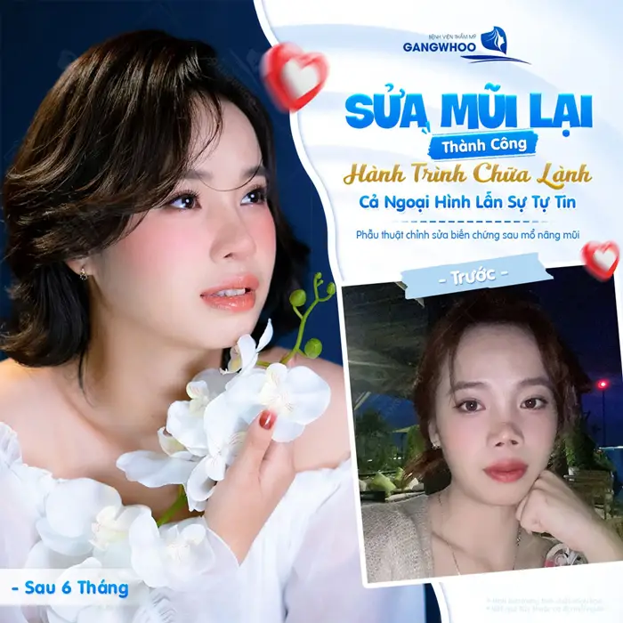 Sửa mũi lại thành công hành trình chữa lành cả ngoại hình lẫn sự tự tin