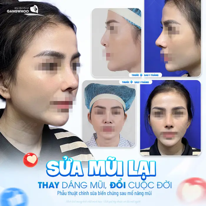 Sửa mũi lại thay dáng mũi mới đổi cuộc đời đầy ấn tượng và rạng rỡ tại BVTM Gangwhoo