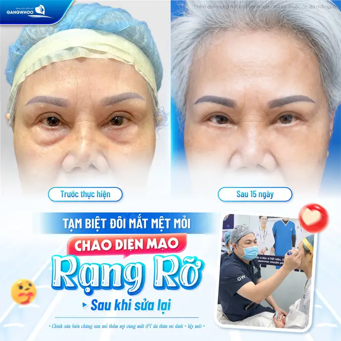 Tạm biệt đôi mắt mệt mỏi chào diện mạo rạng rỡ sau sửa lại tại bệnh viện thẩm mỹ Gangwhoo 