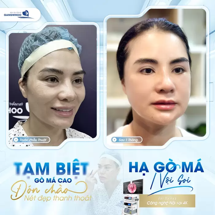 Phẫu Thuật Hạ Gò Má Cao Vi Phẫu Là Gì? Quy Trình Và Chi Phí 10 Tạm biệt gò má cao sớm lấy lại diện mạo đẹp thanh thoát với công nghệ hạ gò má nội soi