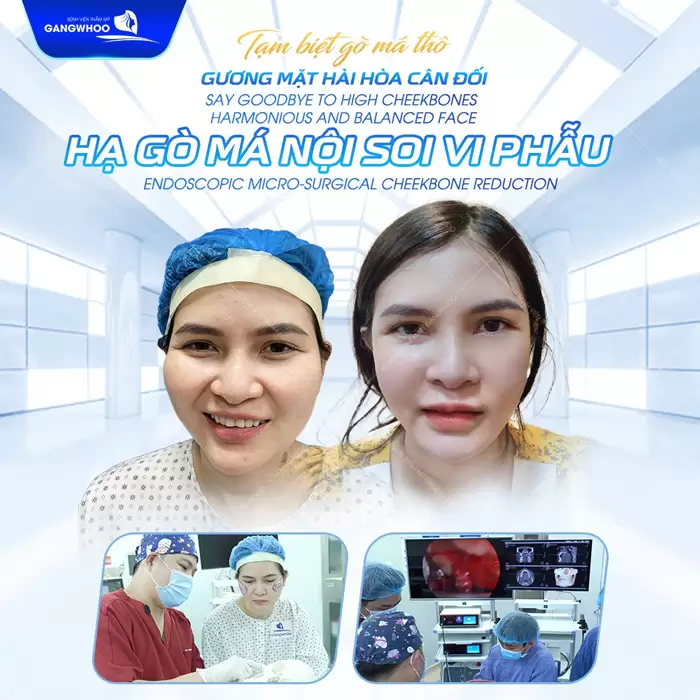 Phẫu Thuật Hạ Gò Má Cao Vi Phẫu Là Gì? Quy Trình Và Chi Phí 1 Tạm biệt gò má thô lấy lại gương mặt cân đối sau phẫu thuật