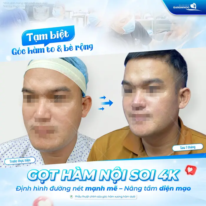 Tạm biệt góc hàm to và bè rộng gọt hàm nội soi 4K định hình đường nét mạnh mẽ nâng tầm diện mạo cho khuôn mặt