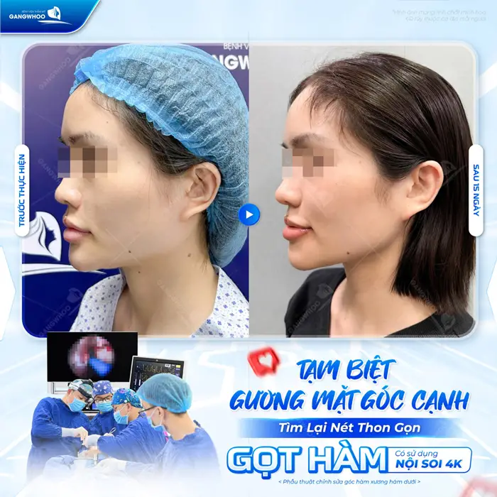 Tạm biệt gương mặt góc hàm tìm lại nét đep thon gọn cho viền hàm thêm cân đối và hài hòa hơn 