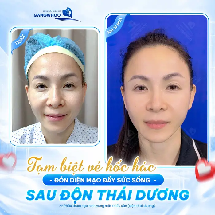Tạm biệt vẻ hốc hác đón diện mạo đầy sức sống sau độn thái dương