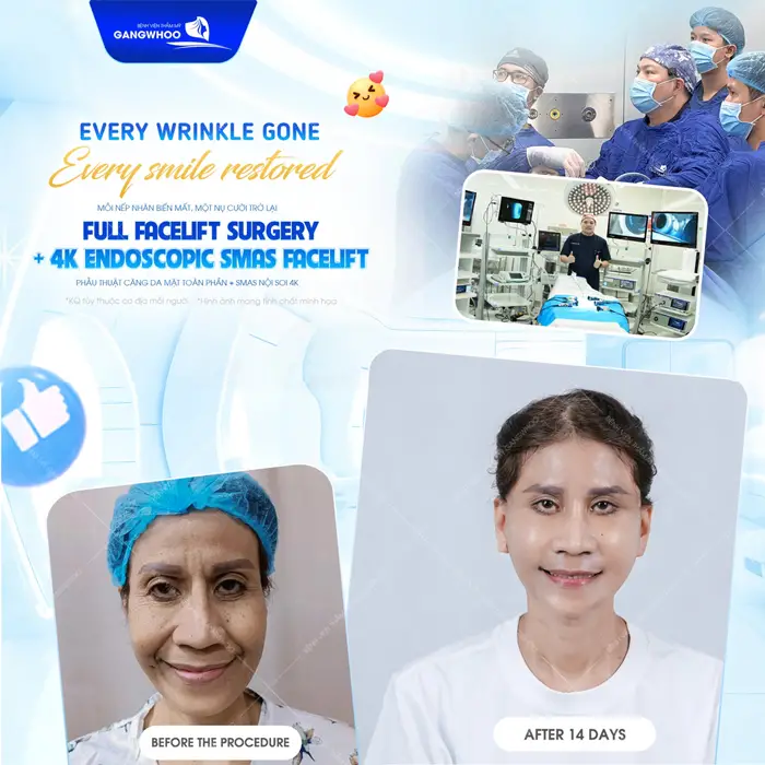 Tạm biệt nếp nhăn chảy xệ, căng da mặt Smas nội soi 4K giải pháp trẻ hóa làn da đẹp toàn diện 