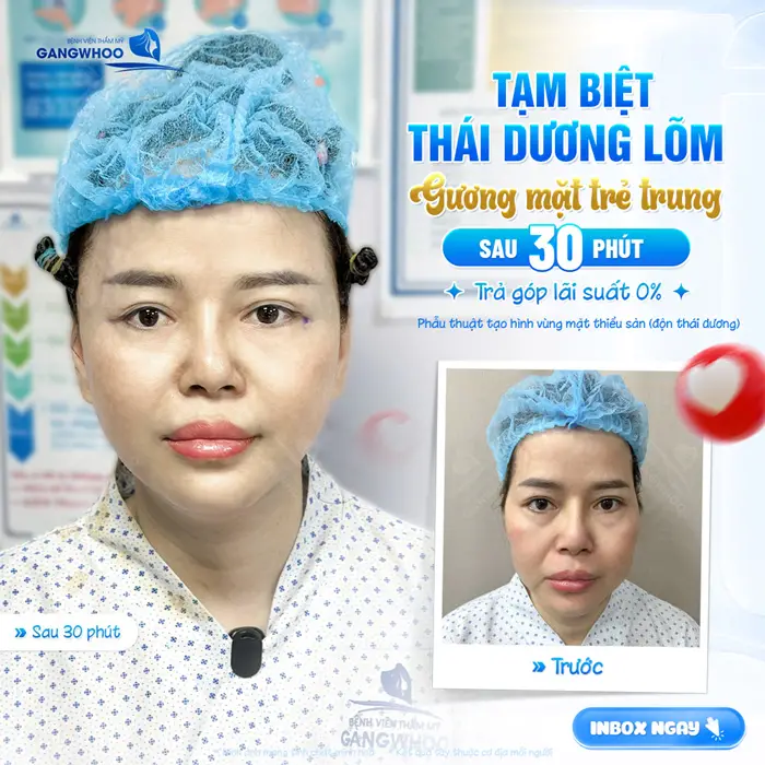 Độn Thái Dương Là Gì? Ưu Điểm Và Chất Liệu Độn 3 Tạm biệt thái dương lõm gương mặt trẻ trung sau 30 phút thực hiện