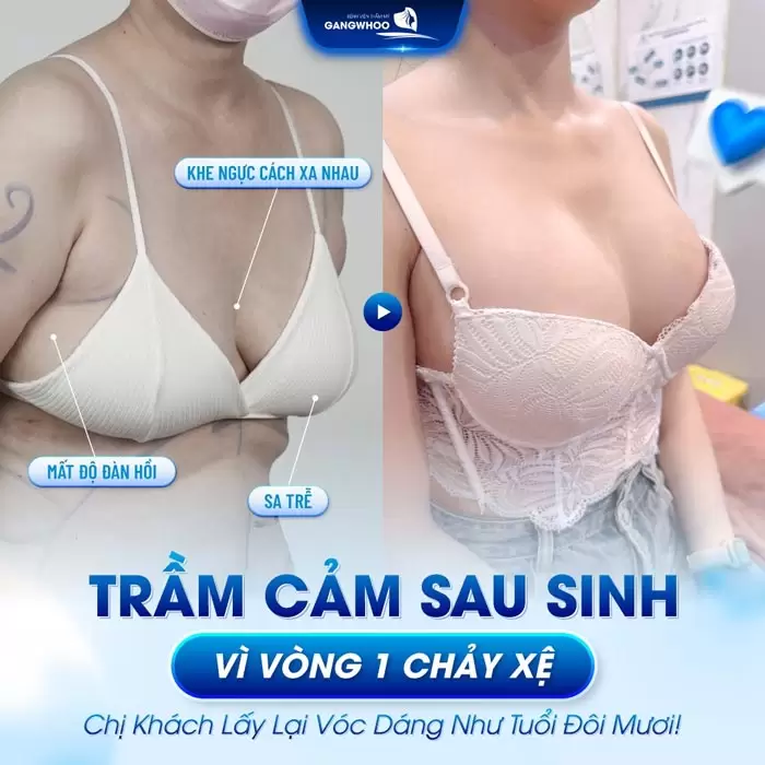 Treo Ngực Sa Trễ Nội Soi 4K Khắc Phục Mọi Cấp Độ Sa Trễ 5 Treo ngực sa trễ