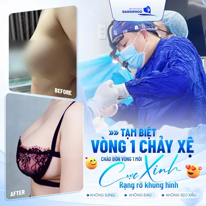 Treo Ngực Sa Trễ Nội Soi 4K Khắc Phục Mọi Cấp Độ Sa Trễ 6 Tạm biệt vòng 1 chảy xệ tự tin khoe vòng 1 mới hoàn hảo và tràn đầy tự tin