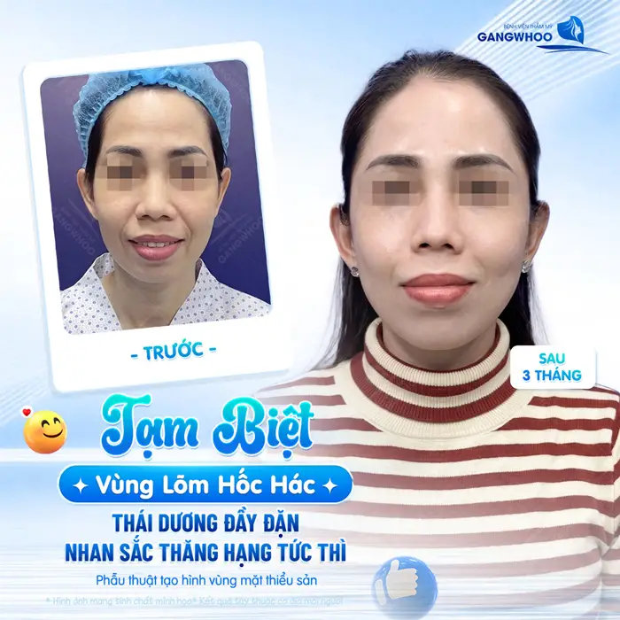 Độn Thái Dương Là Gì? Ưu Điểm Và Chất Liệu Độn 24 Tạm biệt vùng thái dương hốc hác sau 3 tháng thực hiện nay tái khám gương mặt đầy đặn, thăng hạng nhan sắc đẹp tức thì