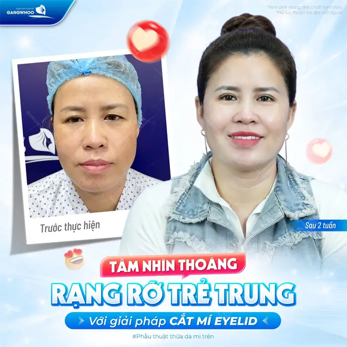 Tầm nhìn mờ rộng, ánh nhìn thêm trẻ trung sau cắt mí Eyelid tại bệnh viện thẩm mỹ Gangwhoo 