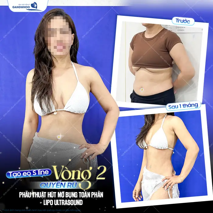 Tạo đường cong S Line vòng 2 quyến rũ cải thiện rõ rệt sau 1 tháng thực hiện 