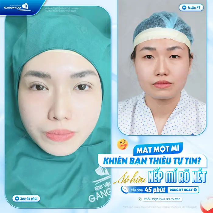 Tạo hình mắt 2 mí rõ nét, chỉ sau 45 phút đã cải thiện ánh nhìn và thần sắc cho khuôn mặt