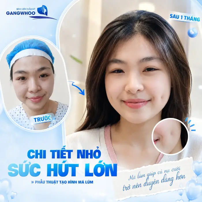 Phẫu thuật tạo hình má lúm chi tiết nhỏ kiến tạo sức hút lớn gương mặt thêm cuốn hút và tự tin