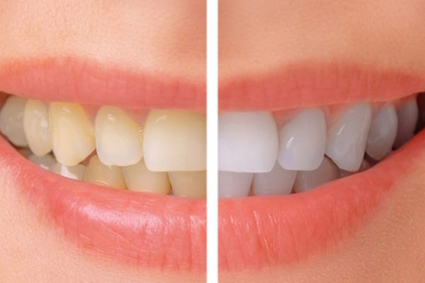 Tẩy trắng răng - Cách làm trắng răng đơn giản