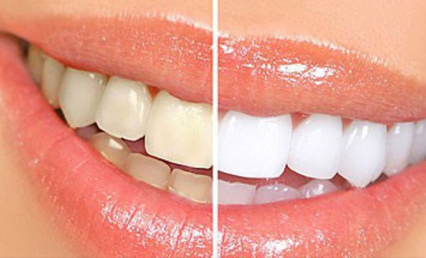 Teeth whitening with laser light at Gangwhoo