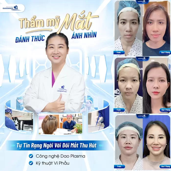 Thẩm mỹ mắt tại bệnh viện thẩm mỹ Gangwhoo đánh thức ánh nhìn tạo nên vẻ đẹp cuốn hút