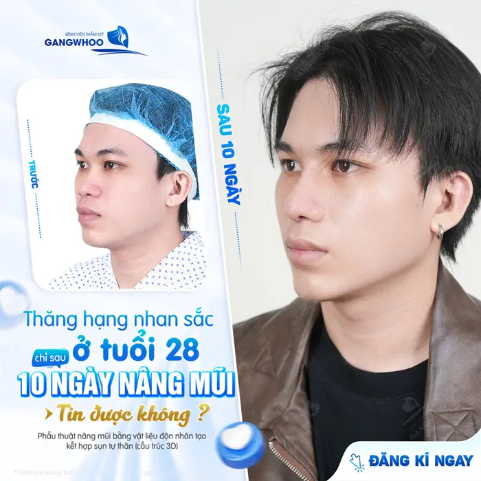 Thăn ghạng nhan sắc ở tuổi 28 sau 10 ngày nâng mũi gương mặt đã hài hòa và cuốn hút hơn thấy rõ