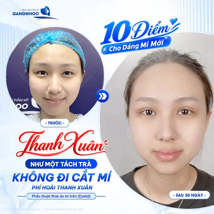 Cắt mí từ sớm cải thiện nét đẹp thanh xuân diện mạo thêm bừng sáng và thăng hạng