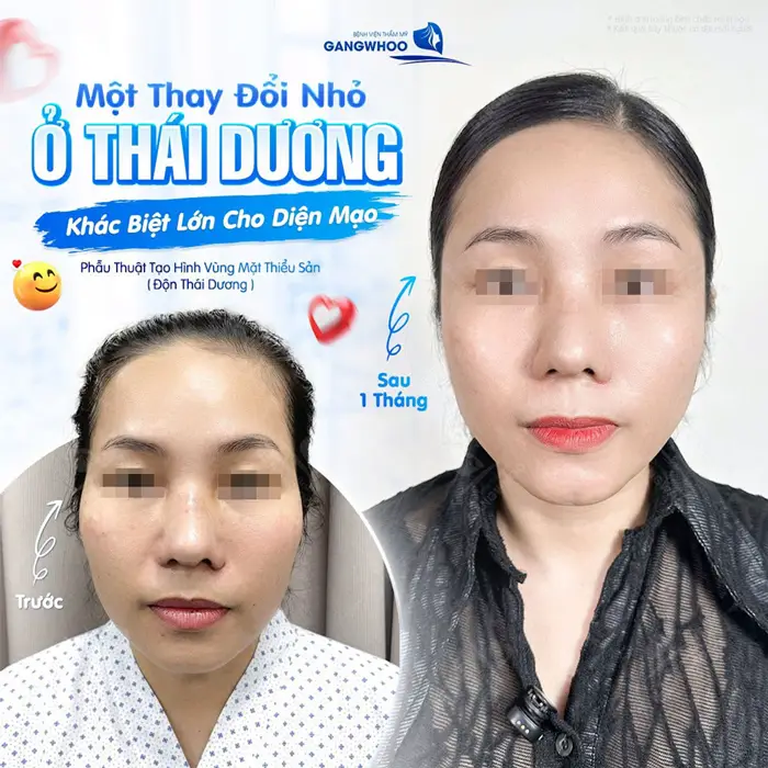 Một thay đổi nhỏ ở thái dương khác biệt lớn cho diện mạo thêm hài hòa và đẹp chuẩn sắc