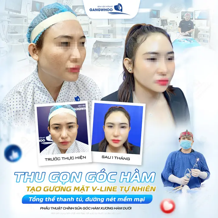 Thu gọn góc hàm tạo gương mặt V line đẹp tự nhiên, tôn nét đẹp mềm mại cho tổng thể gương mặt