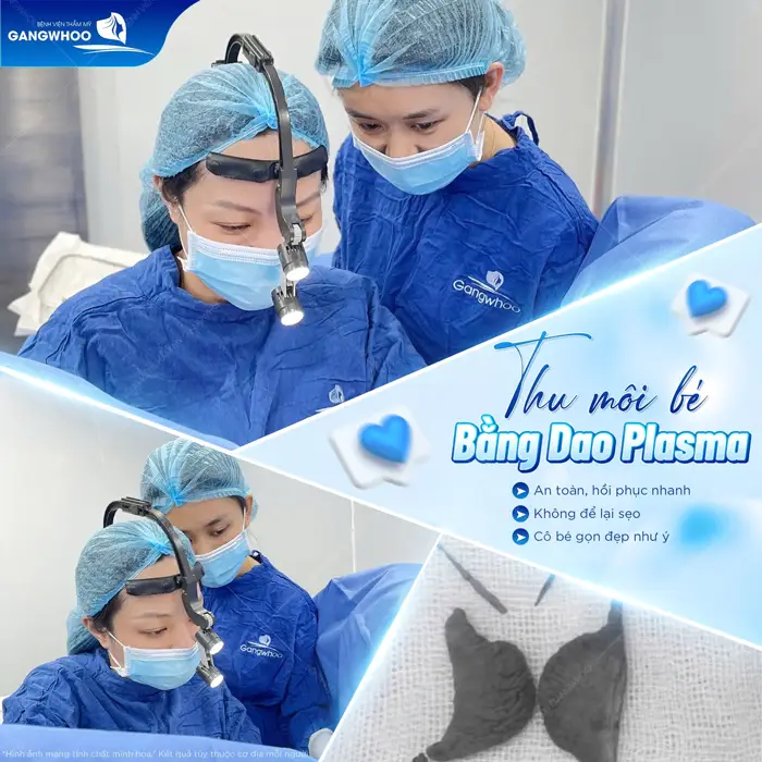 Thu nhỏ môi bé bằng dao Plasma an toàn và nhanh hồi phục