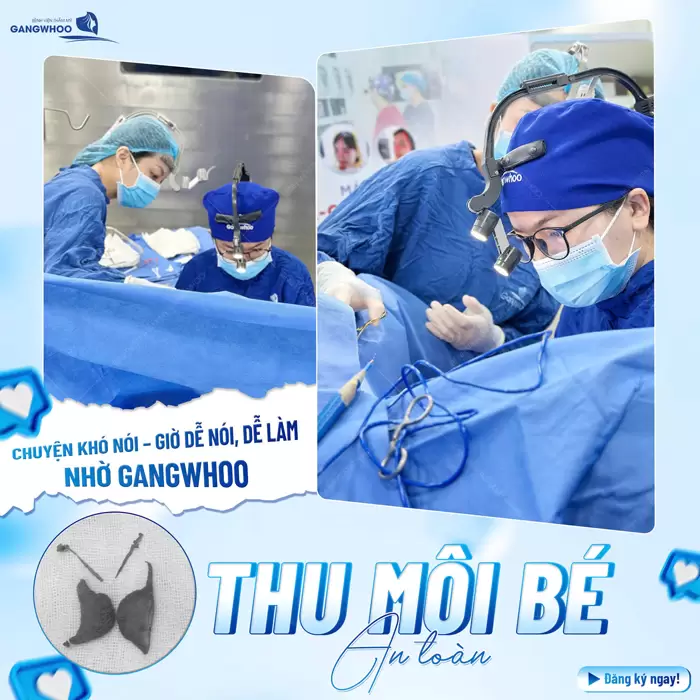 Thu môi bé an toàn nhẹ nhàng không lo đau rát sau phẫu thuật 