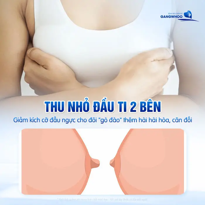 Phẫu Thuật Tái Núm Vú Bằng Vạt Tại Chỗ (Thu Nhỏ Đầu Ti) 2 Bên Giúp Ngực Trẻ Hóa 1 Phẫu Thuật Tái Núm Vú Bằng Vạt Tại Chỗ (Thu Nhỏ Đầu Ti) 2 Bên Giúp Ngực Trẻ Hóa