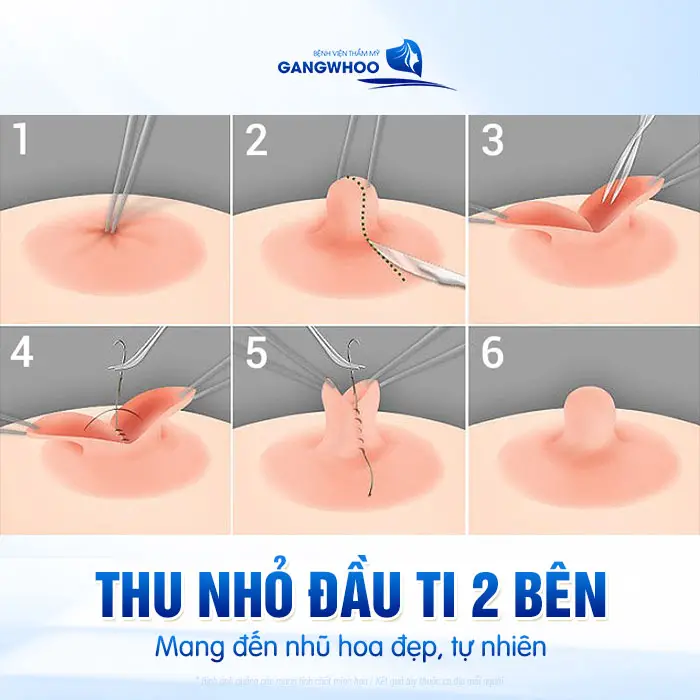 Phẫu Thuật Tái Núm Vú Bằng Vạt Tại Chỗ (Thu Nhỏ Đầu Ti) 2 Bên Giúp Ngực Trẻ Hóa 2 Phẫu Thuật Tái Núm Vú Bằng Vạt Tại Chỗ (Thu Nhỏ Đầu Ti) 2 Bên Giúp Ngực Trẻ Hóa