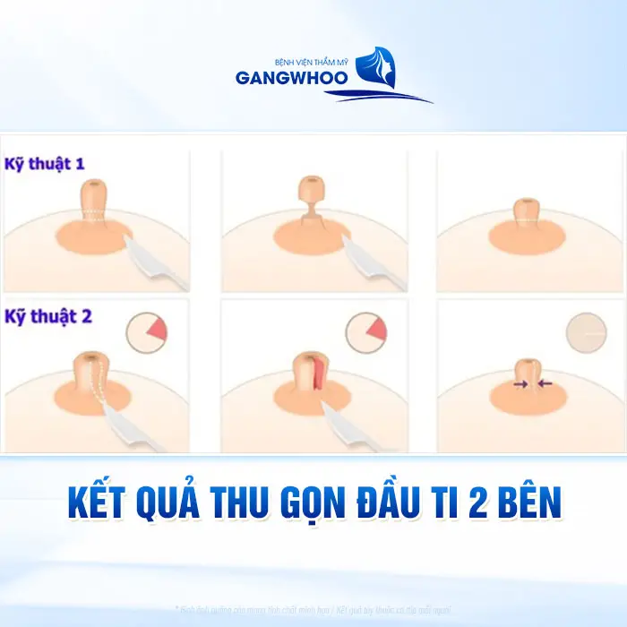 Phẫu Thuật Tái Núm Vú Bằng Vạt Tại Chỗ (Thu Nhỏ Đầu Ti) 2 Bên Giúp Ngực Trẻ Hóa 4 Phẫu Thuật Tái Núm Vú Bằng Vạt Tại Chỗ (Thu Nhỏ Đầu Ti) 2 Bên Giúp Ngực Trẻ Hóa