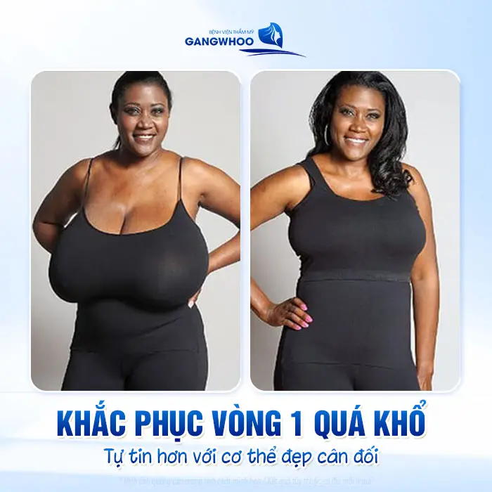 Phẫu Thuật Thu Nhỏ Ngực Phì Đại "Tinh Chỉnh Núi Đôi Gọn Gàng Cân Đối" 3 Phẫu Thuật Thu Nhỏ Ngực Phì Đại "Tinh Chỉnh Núi Đôi Gọn Gàng Cân Đối"