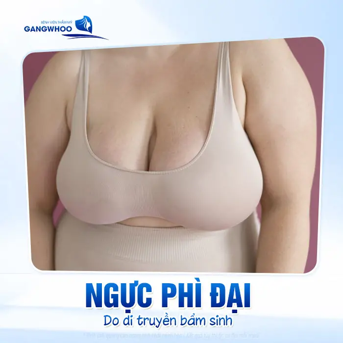 Phẫu Thuật Thu Nhỏ Ngực Phì Đại "Tinh Chỉnh Núi Đôi Gọn Gàng Cân Đối" 1 Phẫu Thuật Thu Nhỏ Ngực Phì Đại "Tinh Chỉnh Núi Đôi Gọn Gàng Cân Đối"