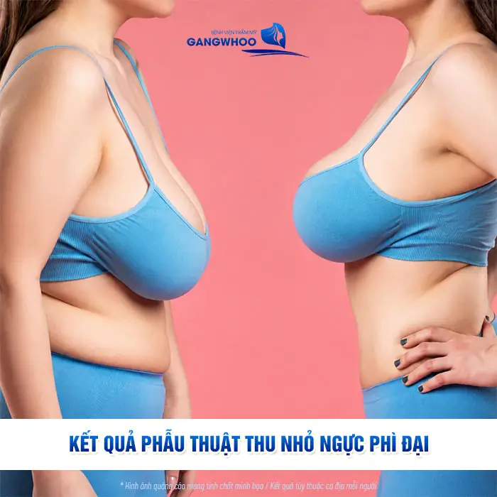 Phẫu Thuật Thu Nhỏ Ngực Phì Đại "Tinh Chỉnh Núi Đôi Gọn Gàng Cân Đối" 5 Phẫu Thuật Thu Nhỏ Ngực Phì Đại "Tinh Chỉnh Núi Đôi Gọn Gàng Cân Đối"