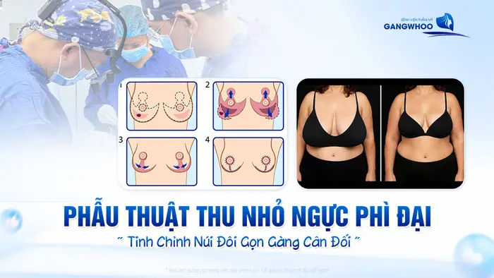 thu nho nguc phi dai