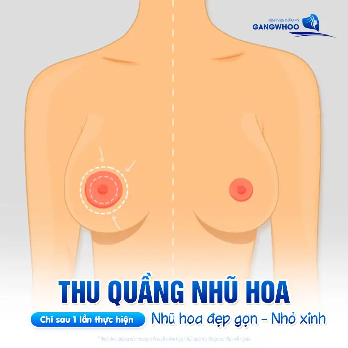 Thu Nhỏ Quầng Vú Hai Bên Cho Bầu Ngực Thêm Xinh Đẹp Hồng Hào